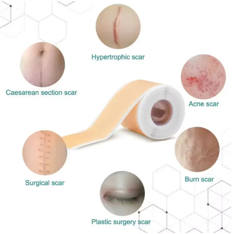 Silicone Scar Strip 4x150cm